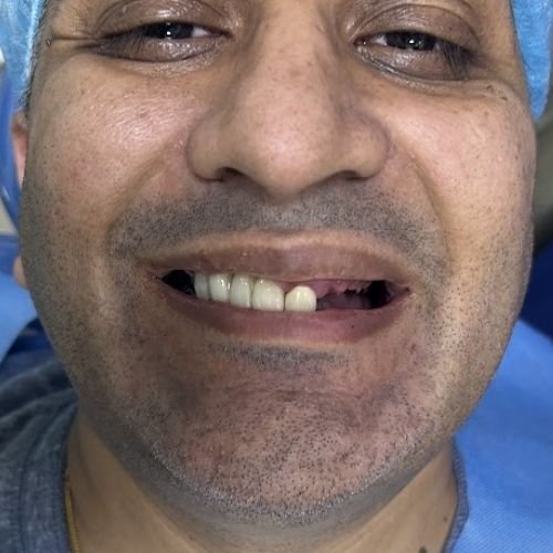Before Dental Implant Treatment