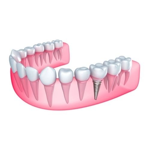 MDS in Prosthodontics