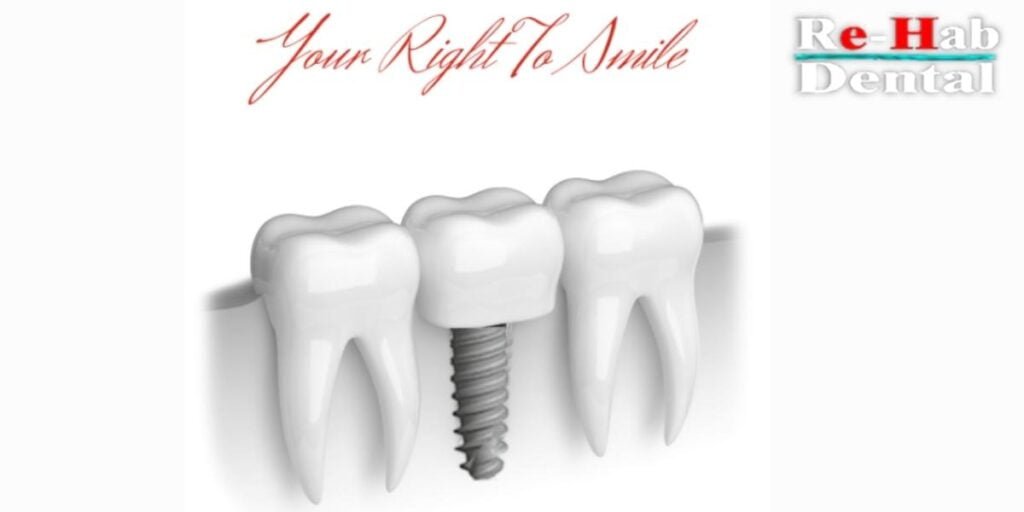 Dental Implant Design and Its Relationship to Long-Term Implant Success