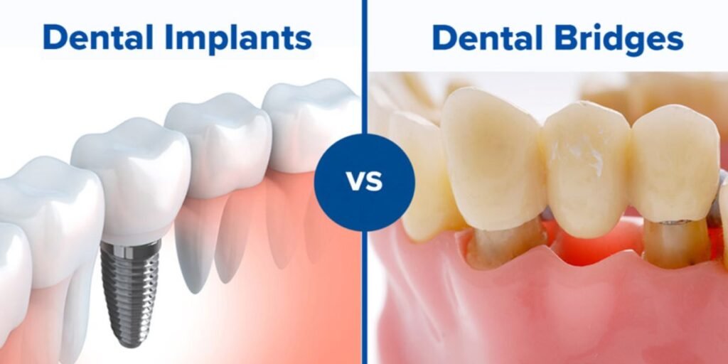 The Great Debate Dental Implants or Bridges