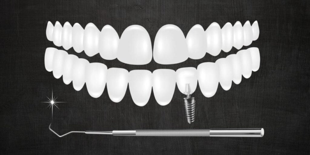 The Complete Guide to Maintaining Implant-Supported Dentures