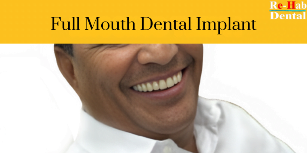 Best Dentist Near Me - Re-Hab Dental - Understanding Full Mouth Dental Implant Costs full mouth dental implant, complete dental restoration, dental implants, full mouth reconstruction, best dental implants