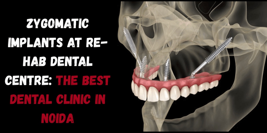 Best Dentist Near Me - Re-Hab Dental - Zygomatic Implants at Re-Hab Dental Centre: The Best Dental Clinic in Noida Zygomatic Implants treatment, advanced dental implants, permanent teeth replacement, bone loss solution, best implant dentist, full mouth dental restoration