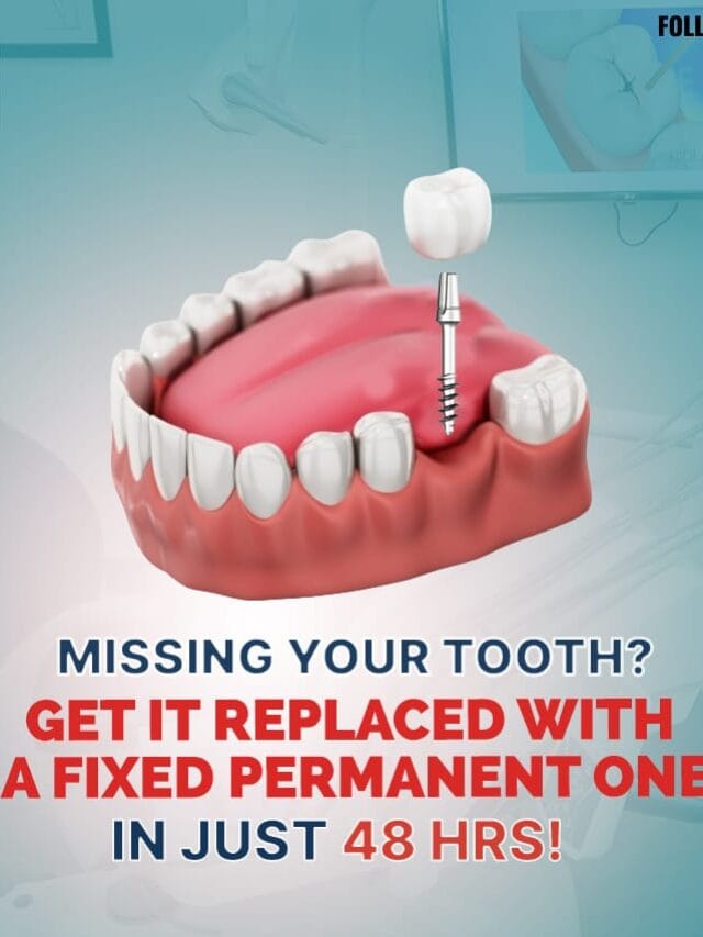 Get Your Smile Back on Track in 48 Hours – Immediate Dental Implants & Permanent Teeth